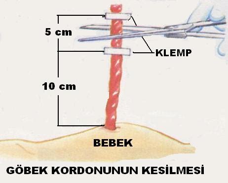 Kordonun değiştirilme yöntemleri